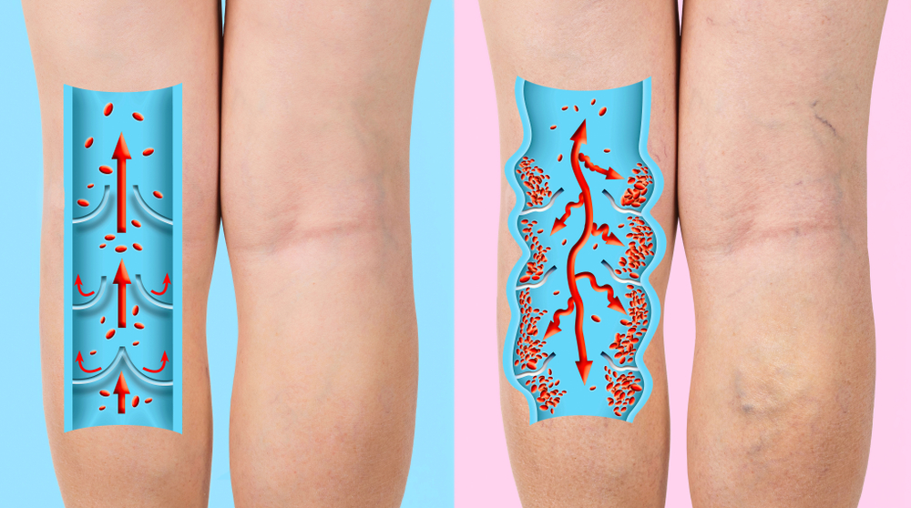 Varicose,Veins,On,A,Female,Senior,Legs.,The,Structure,Of Varicose,Veins,On,A,Female,Senior,Legs.,The,Structure,Of