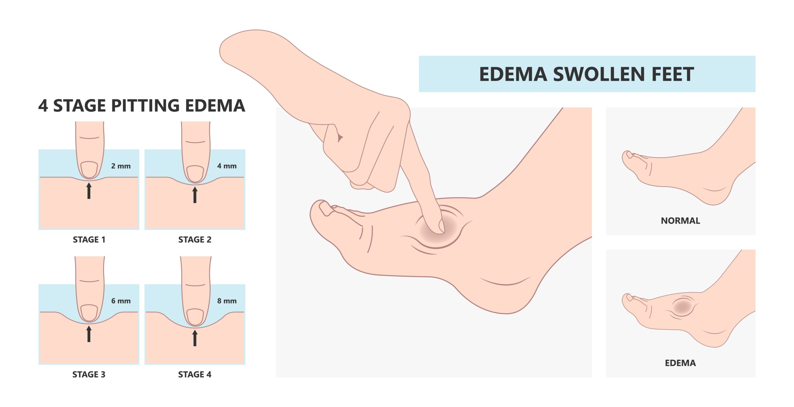 Meige’s,Syndrome,Milroy,Leg,Edema,Venous,Deep,Vein,Cancer,Swelling Meige’s,Syndrome,Milroy,Leg,Edema,Venous,Deep,Vein,Cancer,Swelling