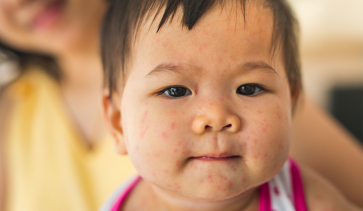 Mononucleosis