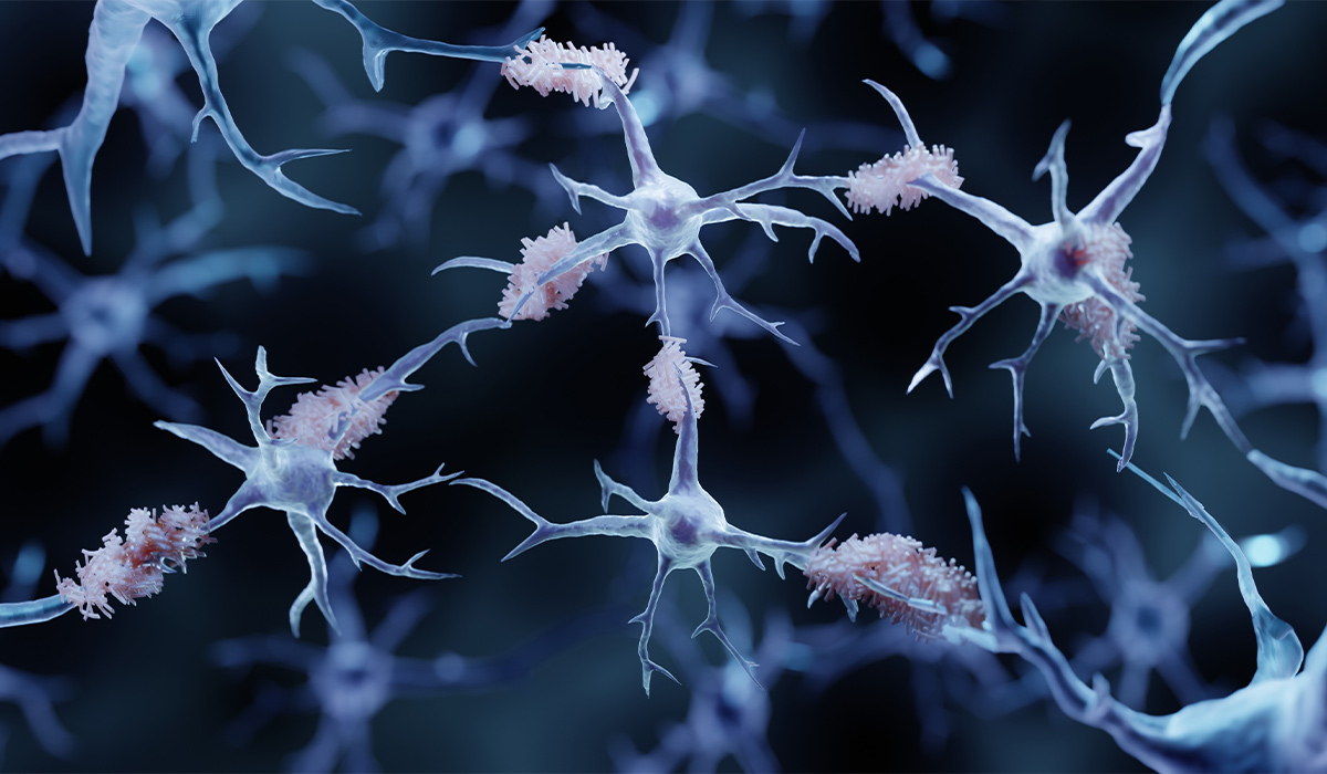 Amyloidosis: What Is, Types, Causes, Tests, and Treatments