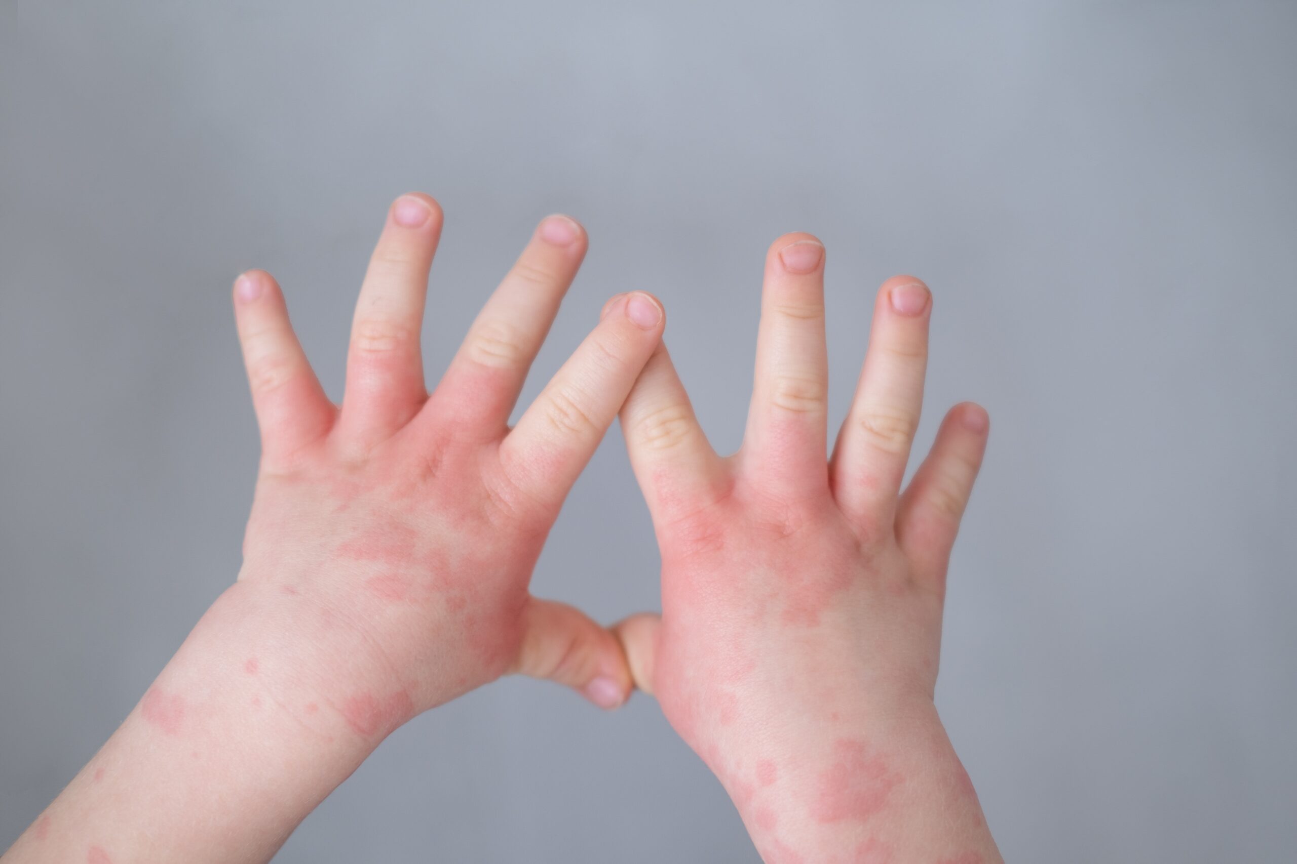 Close,Up,Kids,Hand,With,Allergic,Rash,Or,Eczema.,Severe