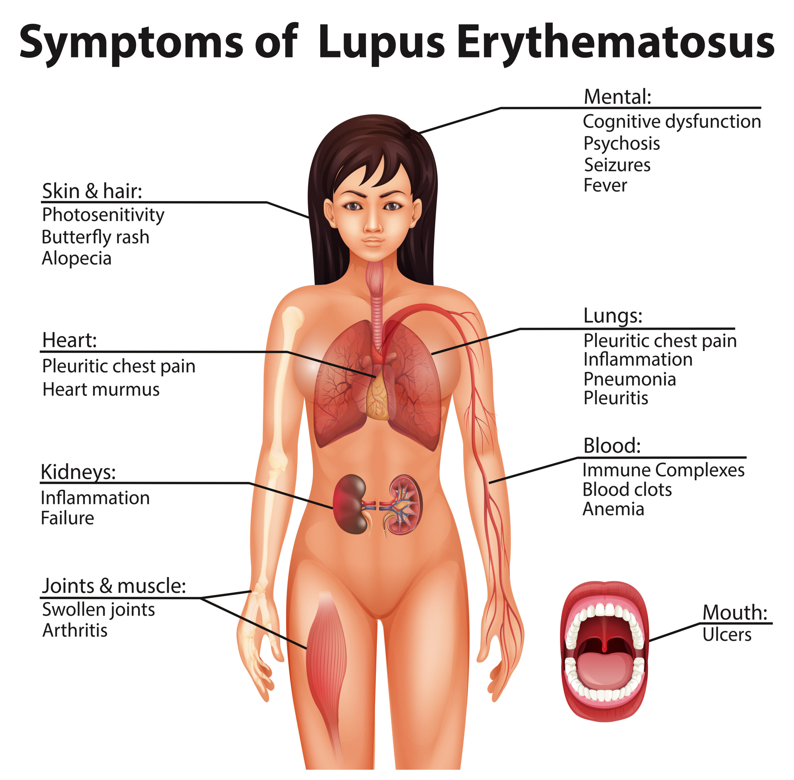Human,Anatomy,Symptoms,Of,Lupus,Erythematosus,Illustration Human,Anatomy,Symptoms,Of,Lupus,Erythematosus,Illustration