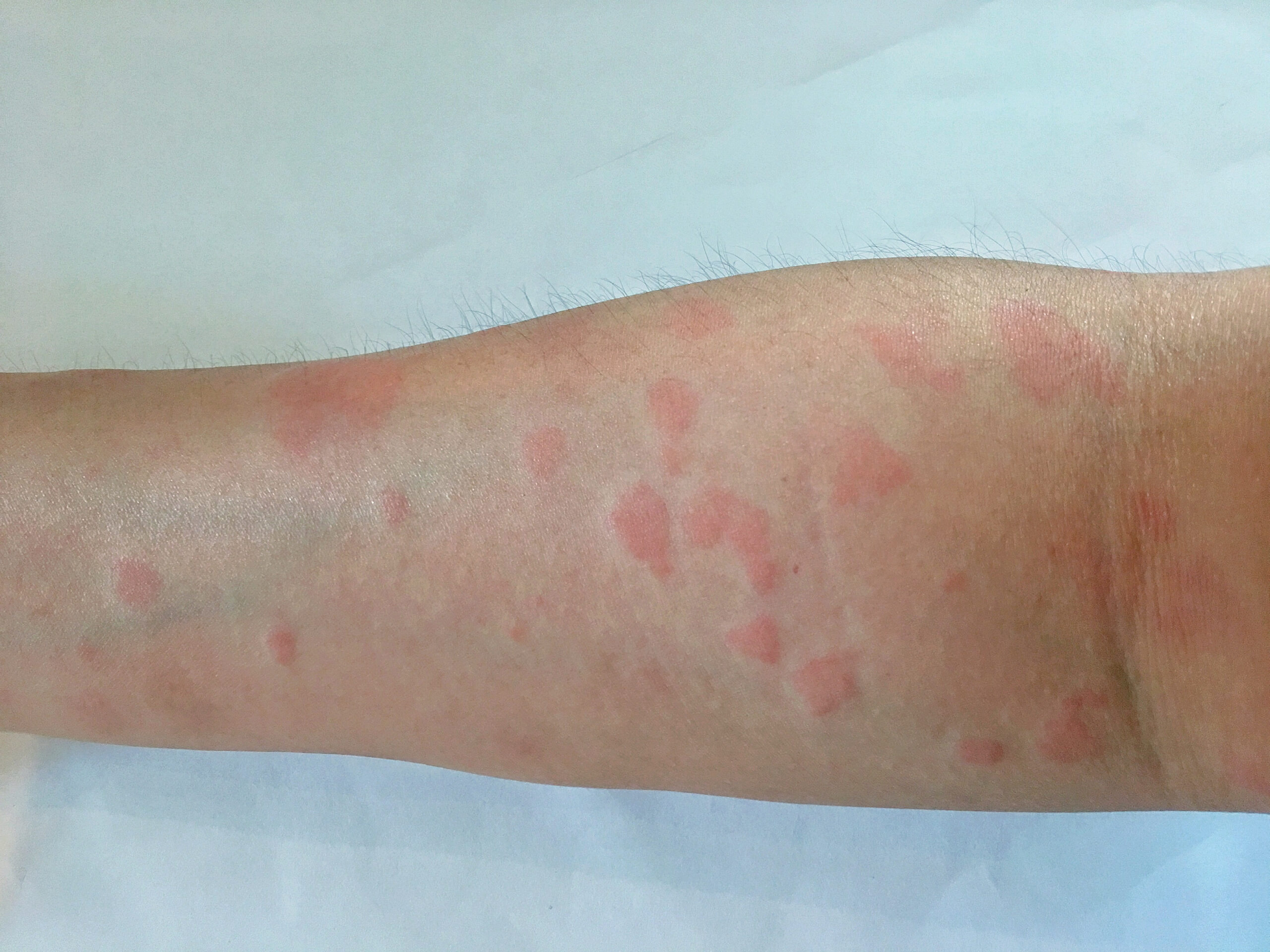 Systemic,Lupus,Erythematosus(sle),Is,A,Chronic,Disease,Caused,By,Self-immunity Systemic,Lupus,Erythematosus(sle),Is,A,Chronic,Disease,Caused,By,Self-immunity