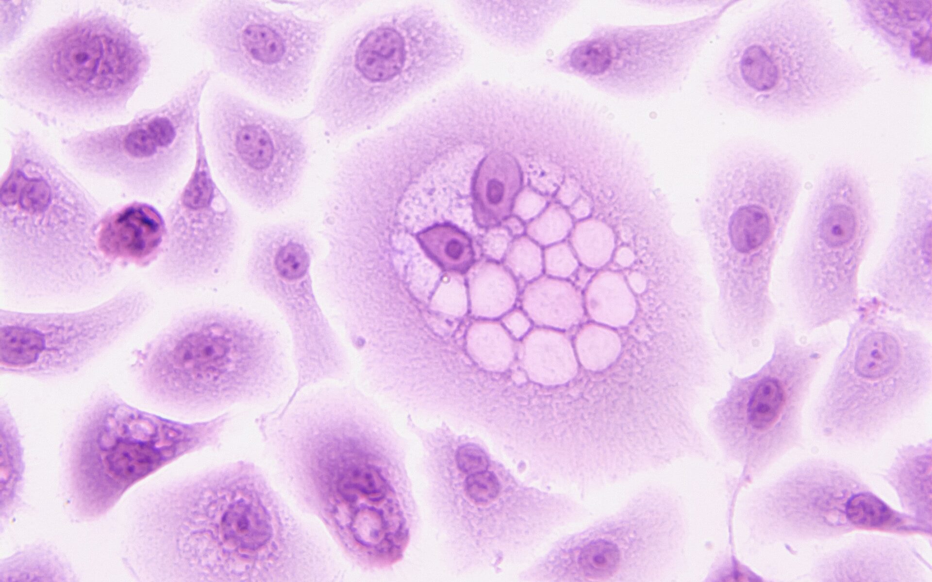 pancreatic-cancer-941340 pancreatic-cancer-941340