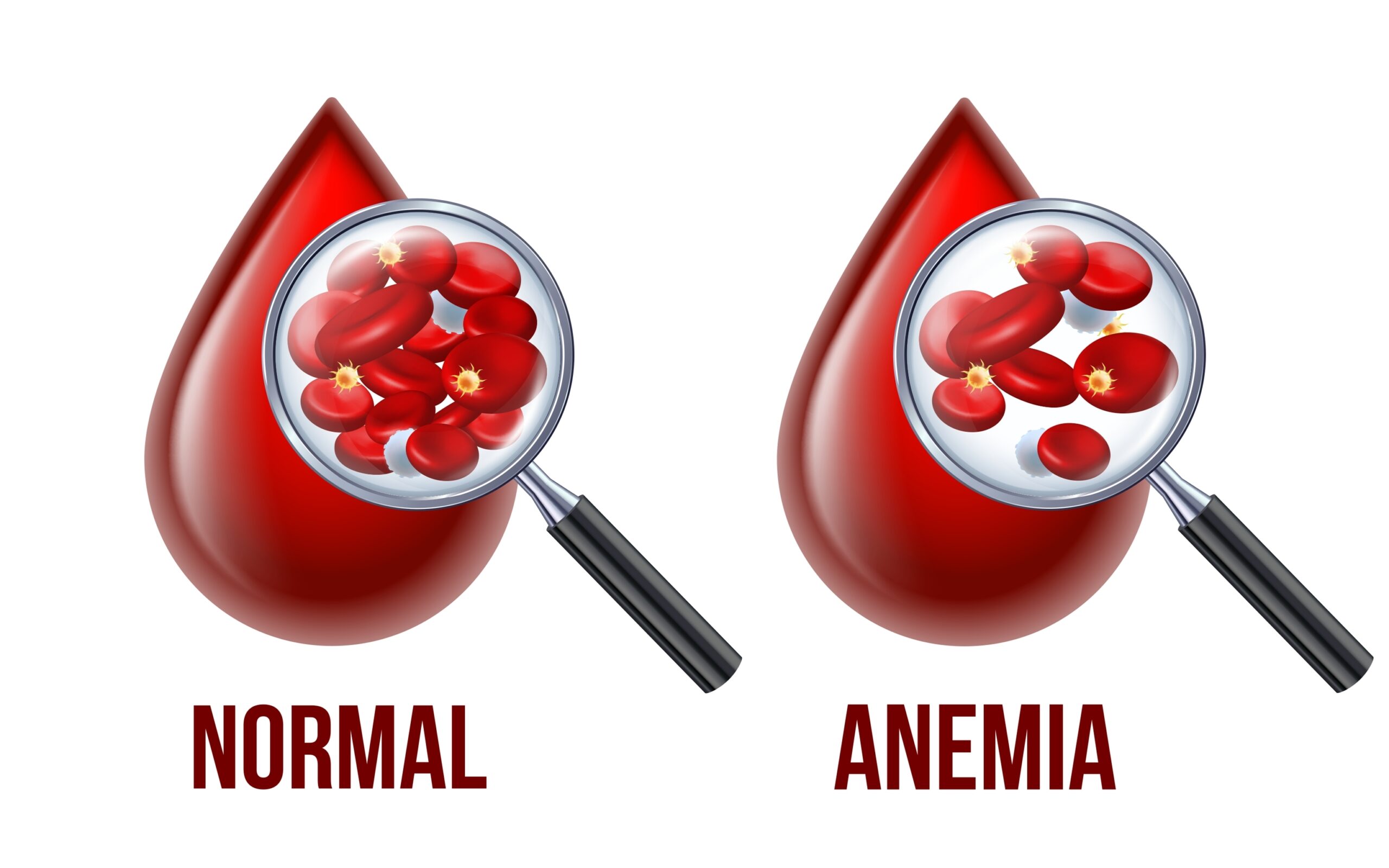 Iron,Deficiency,Anemia.the,Difference,Of,Anemia,Amount,Of,Red,Blood Iron,Deficiency,Anemia.the,Difference,Of,Anemia,Amount,Of,Red,Blood