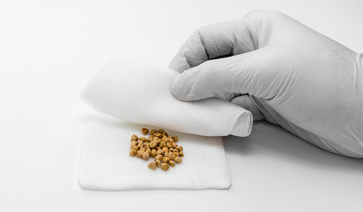 Gallstones (Cholelithiasis)