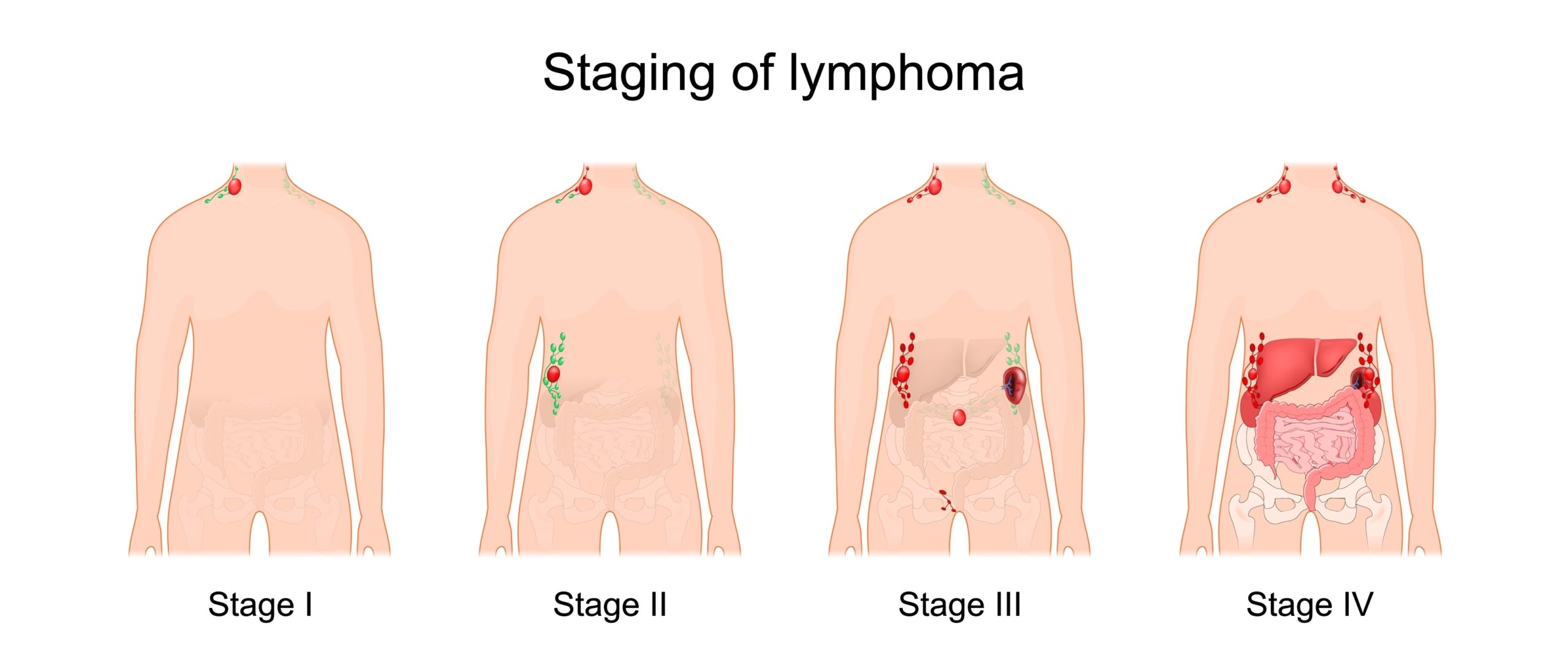 Stage,Of,A,Lymphoma.,Cancer,Of,The,Lymphatic,System.,Signs