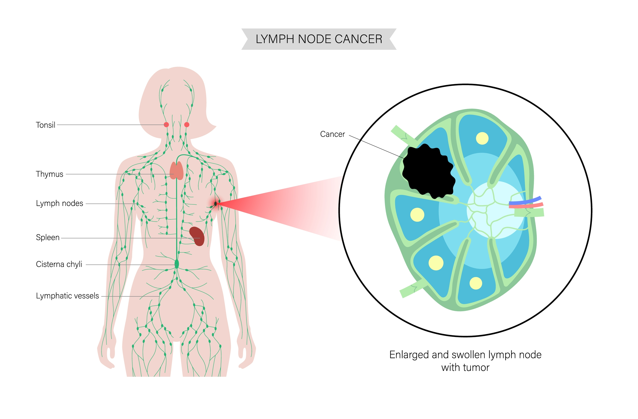 Anatomy,Of,Lymph,Node,With,Tumor,Cells,In,Woman,Silhouette.