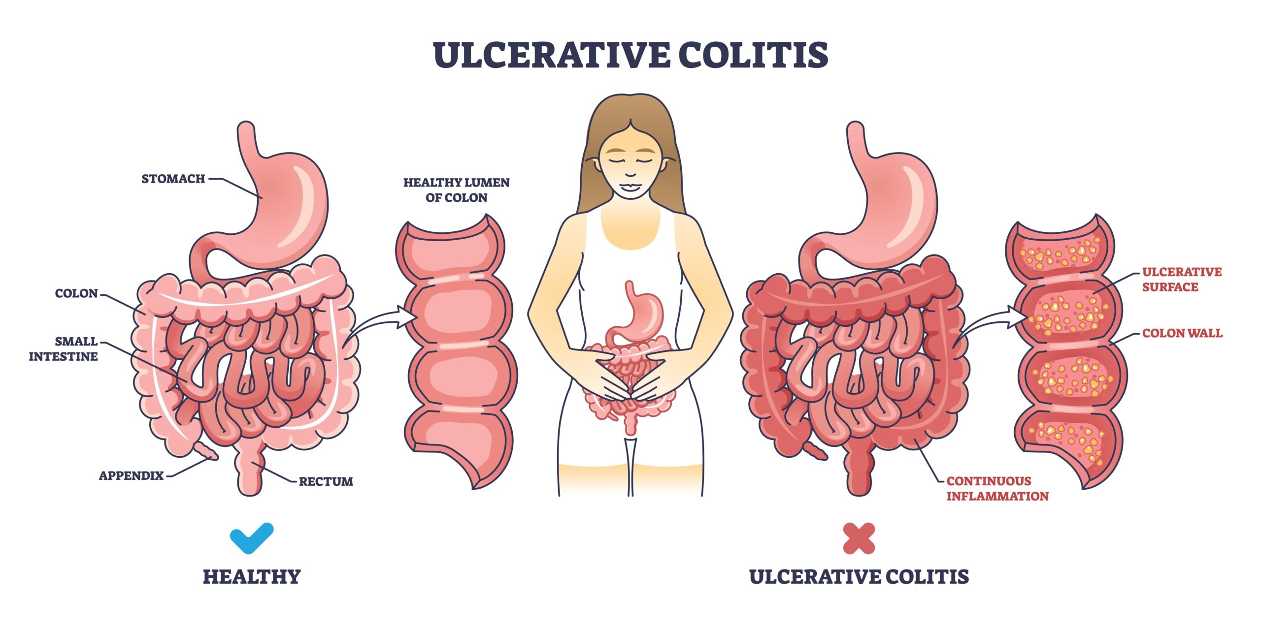 Ulcerative,Colitis,As,Chronic,Inflammatory,Bowel,Disease,Outline,Diagram.,Labeled Ulcerative,Colitis,As,Chronic,Inflammatory,Bowel,Disease,Outline,Diagram.,Labeled