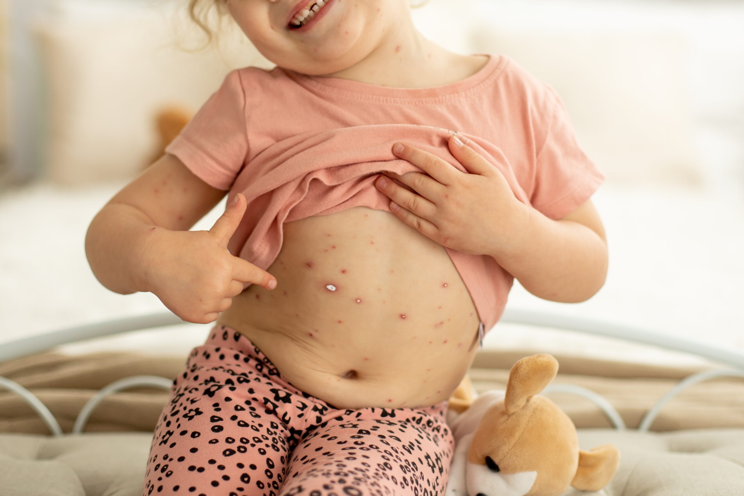 Little,Toddler,Girl,With,Chicken,Pox,In,Bed,,Playing,At Little,Toddler,Girl,With,Chicken,Pox,In,Bed,,Playing,At