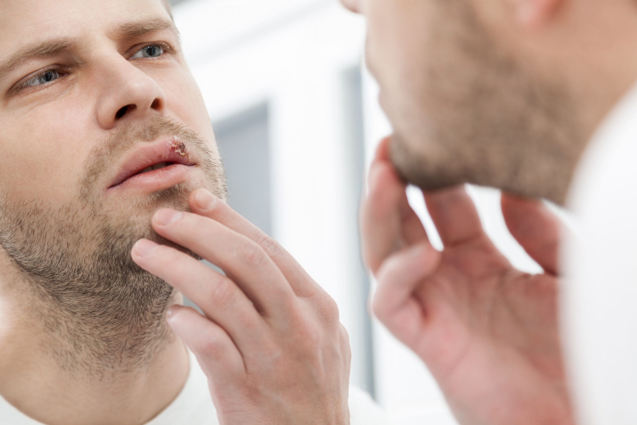 Young,Man,Suffering,From,Painful,Herpes,On,His,Mouth Young,Man,Suffering,From,Painful,Herpes,On,His,Mouth