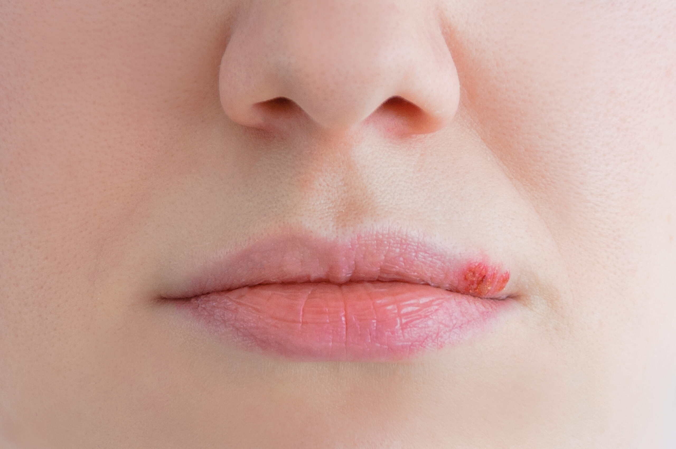 Herpes,On,The,Lip,Of,A,Caucasian,Woman.,Face,Close-up. Herpes,On,The,Lip,Of,A,Caucasian,Woman.,Face,Close-up.