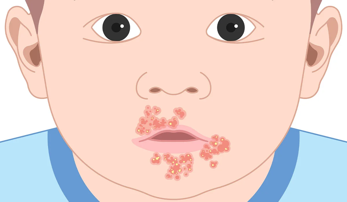 Impetigo