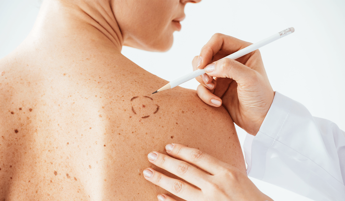 Melanoma