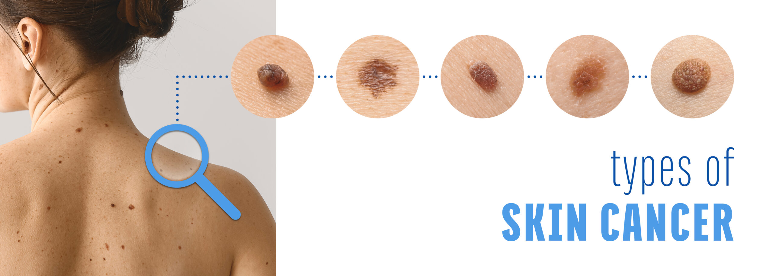 Types of Melanoma Types of Melanoma