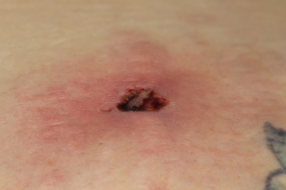Spider Bite Spider Bite