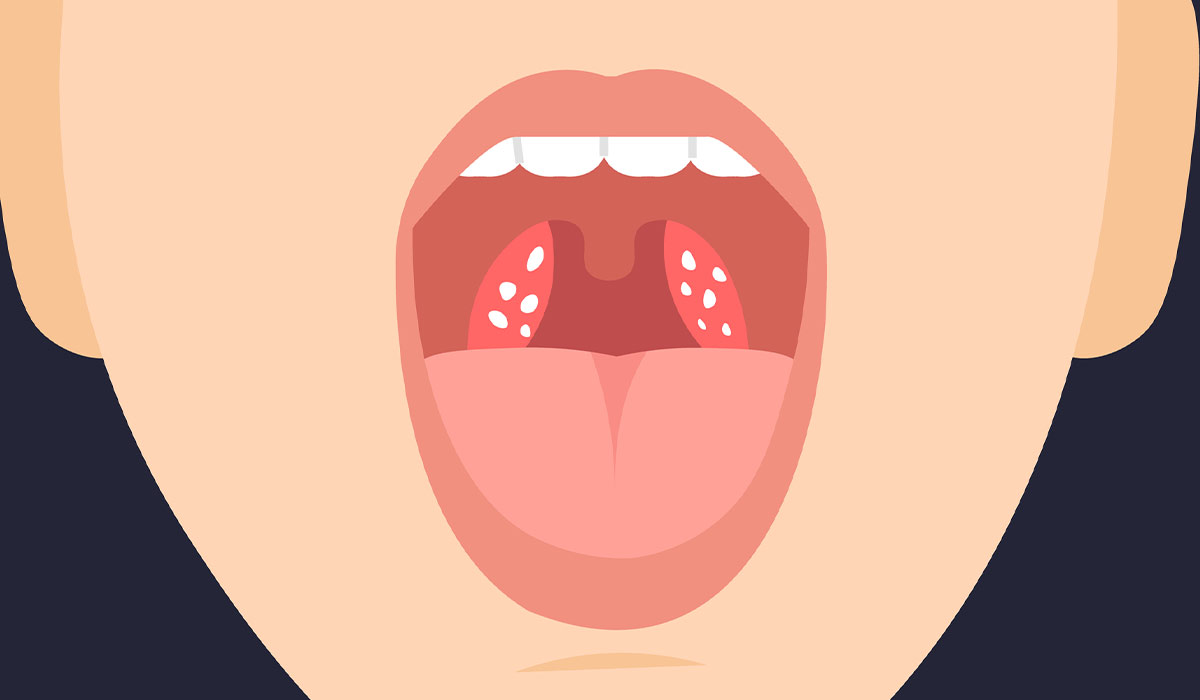 Tonsil Stones