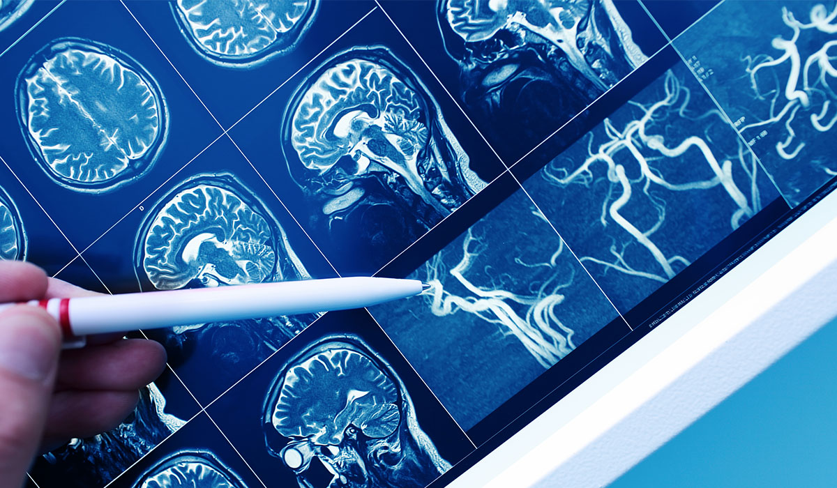 Vascular Dementia