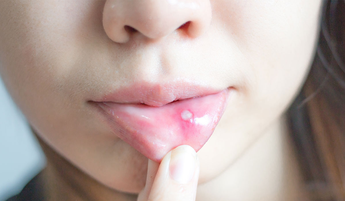 Oral Thrush