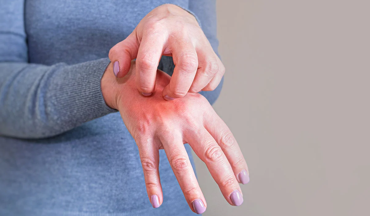 Scabies