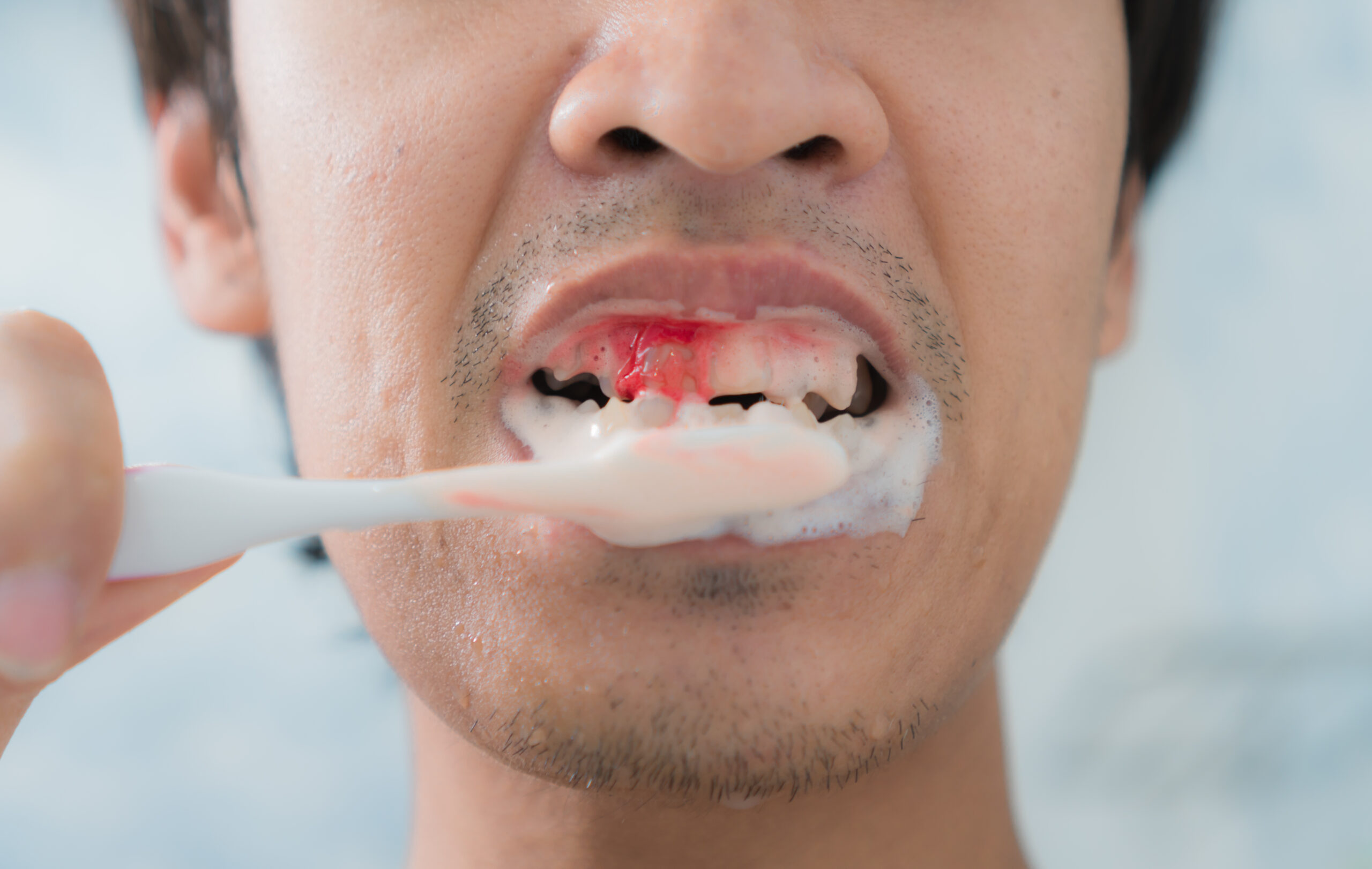 Bleeding,At,Teeth,During,Brushing,With,Toothbrush.scurvy Bleeding,At,Teeth,During,Brushing,With,Toothbrush.scurvy