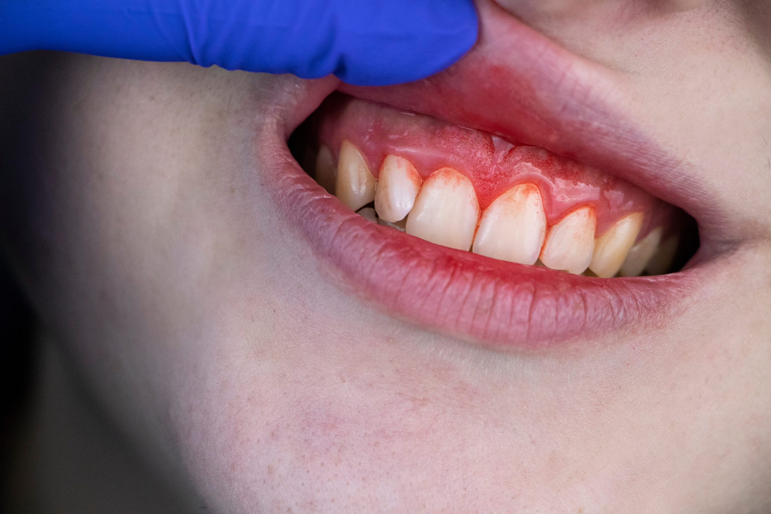 Gum,Bleeding,And,Inflammation,Close,Up.,A,Man,Examined,By Gum,Bleeding,And,Inflammation,Close,Up.,A,Man,Examined,By