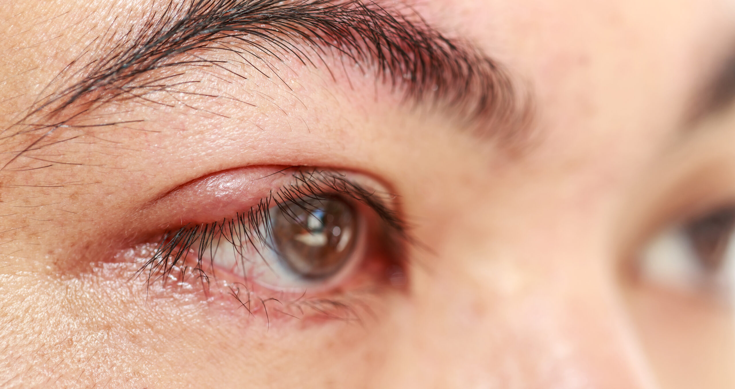 Close,Up,Right,Upper,Eye,Lid,Abscess,”stye,Or,Hordeolum” Close,Up,Right,Upper,Eye,Lid,Abscess,”stye,Or,Hordeolum”