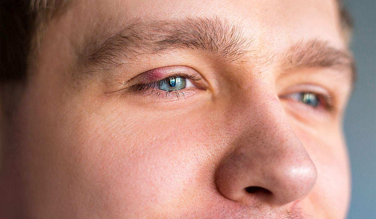 Stye