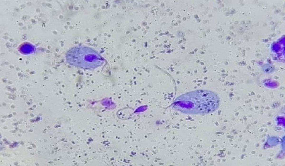 Trichomoniasis