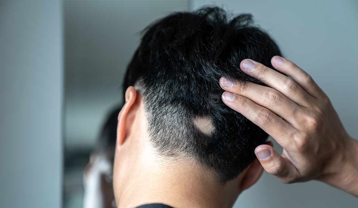 Alopecia