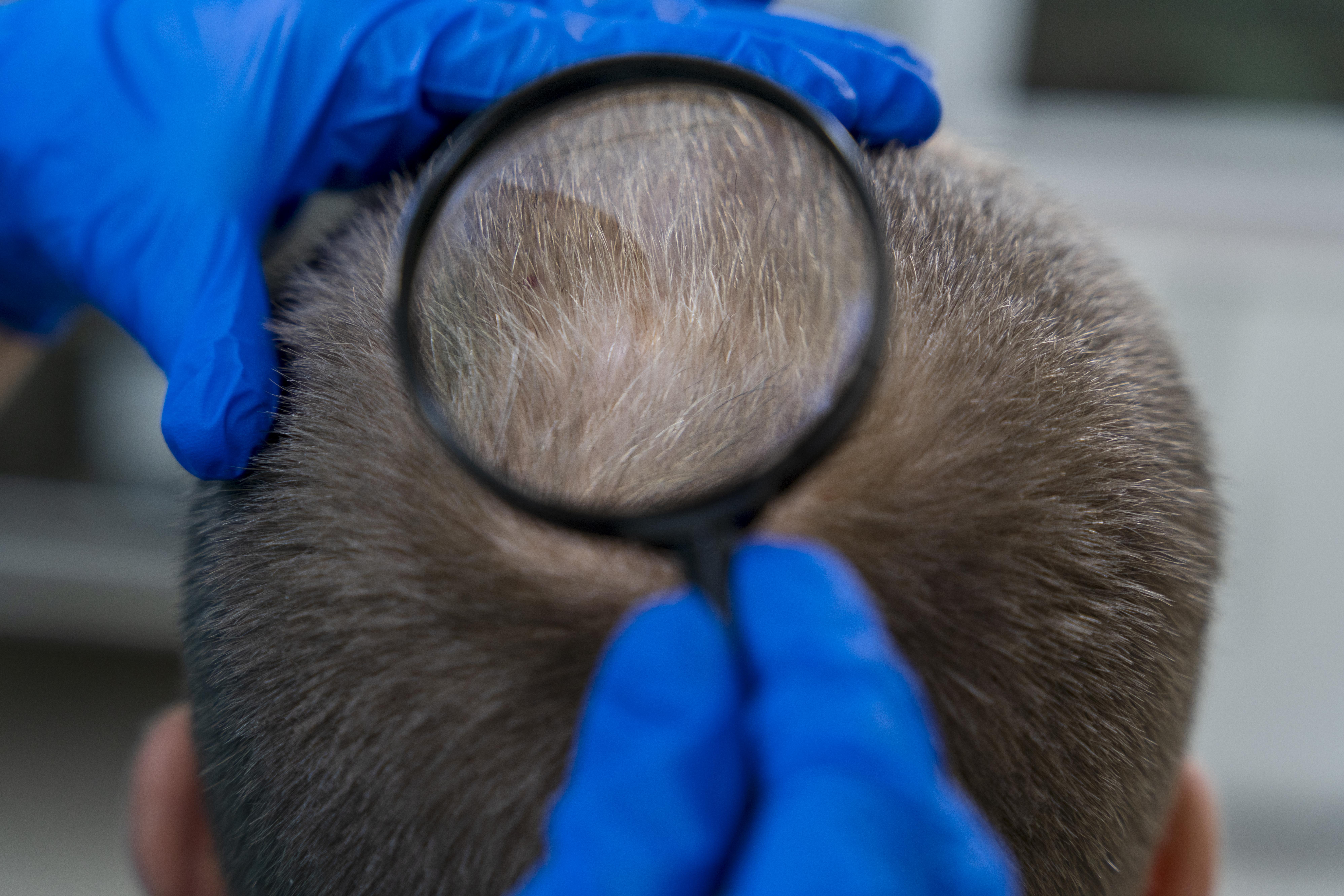 alopecia-what-is-types-key-symptoms-amp-causes-839459 alopecia-what-is-types-key-symptoms-amp-causes-839459