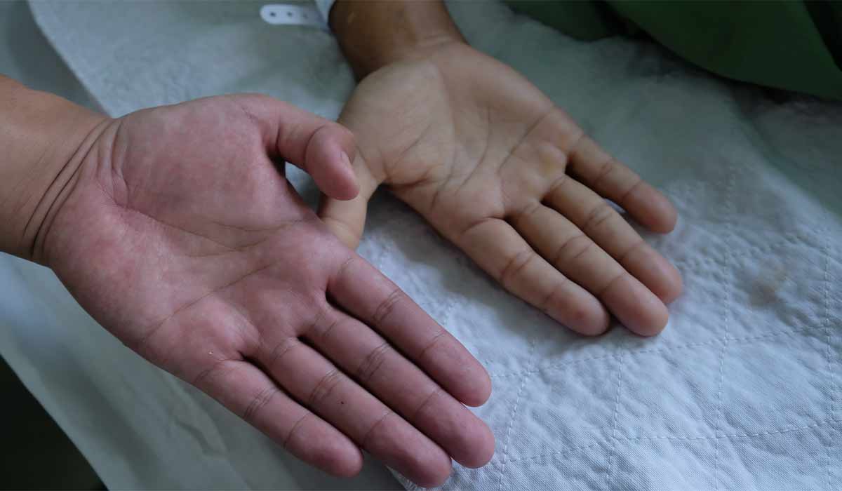 Aplastic Anemia