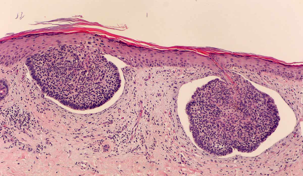 Basal Cell Carcinoma