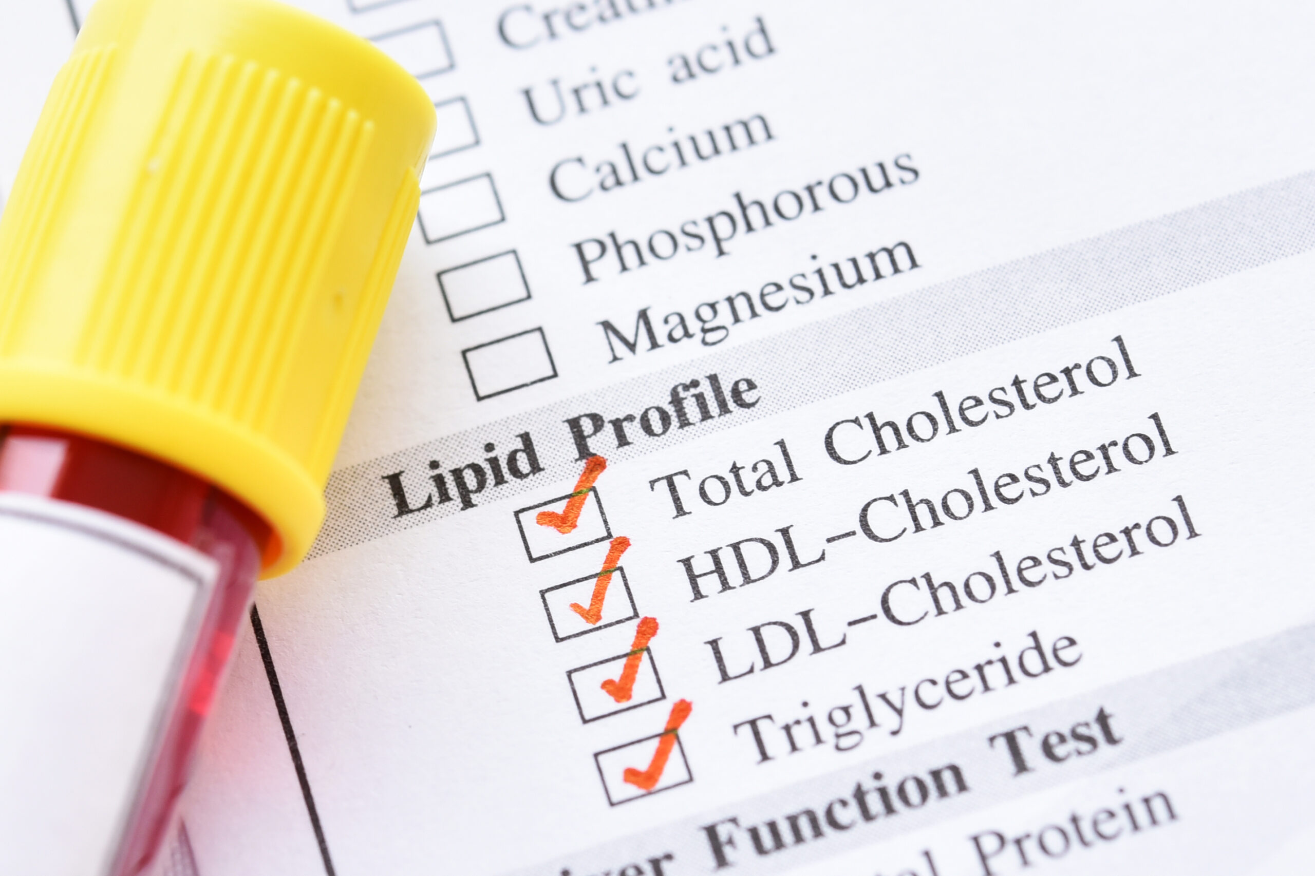 Blood,Sample,For,Lipid,Profile,Test Blood,Sample,For,Lipid,Profile,Test