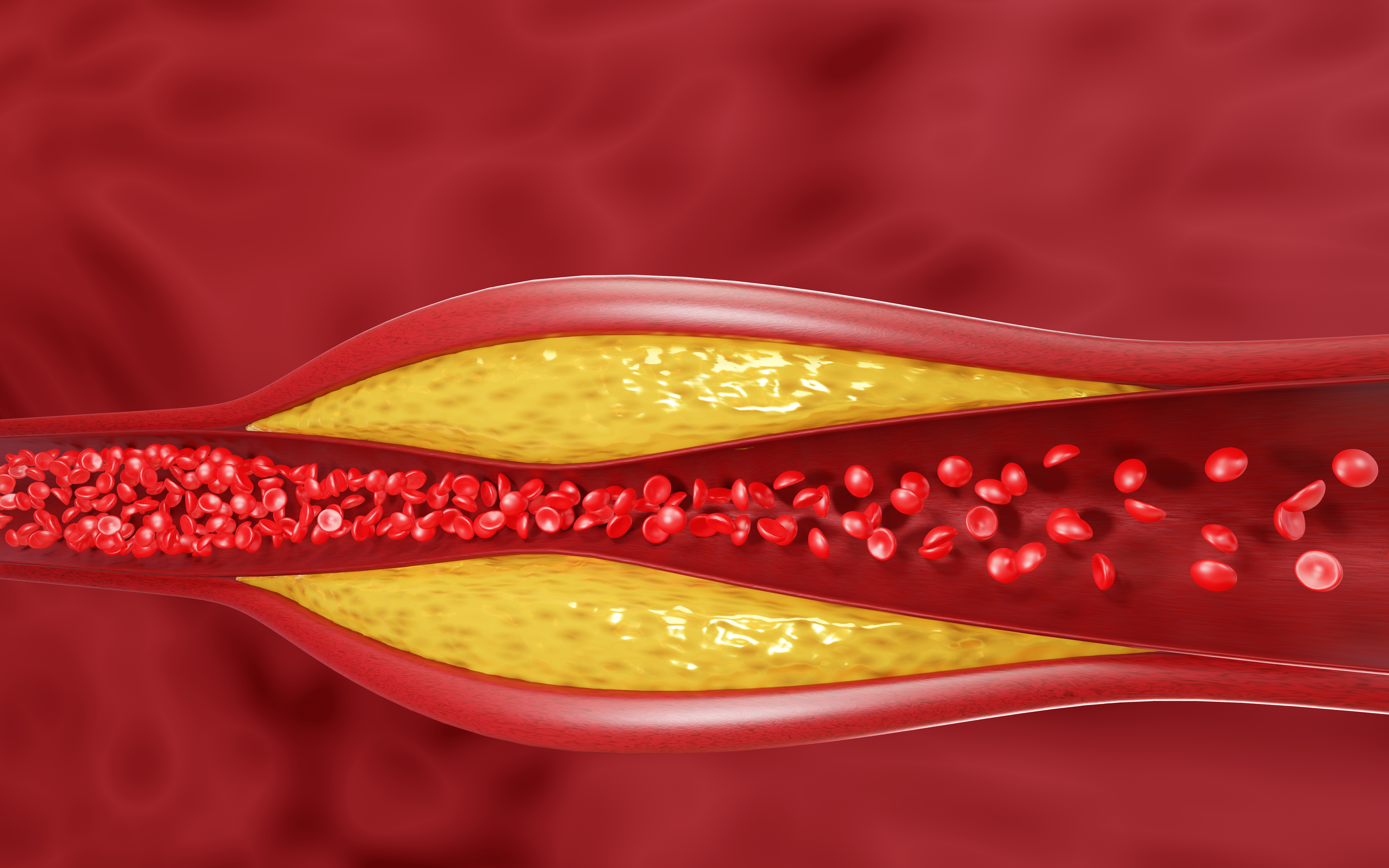 Hyperlipidemia,Or,Arteriosclerosis.,Blocked,Artery,Concept,And,Human,Blood,Vessel Hyperlipidemia,Or,Arteriosclerosis.,Blocked,Artery,Concept,And,Human,Blood,Vessel