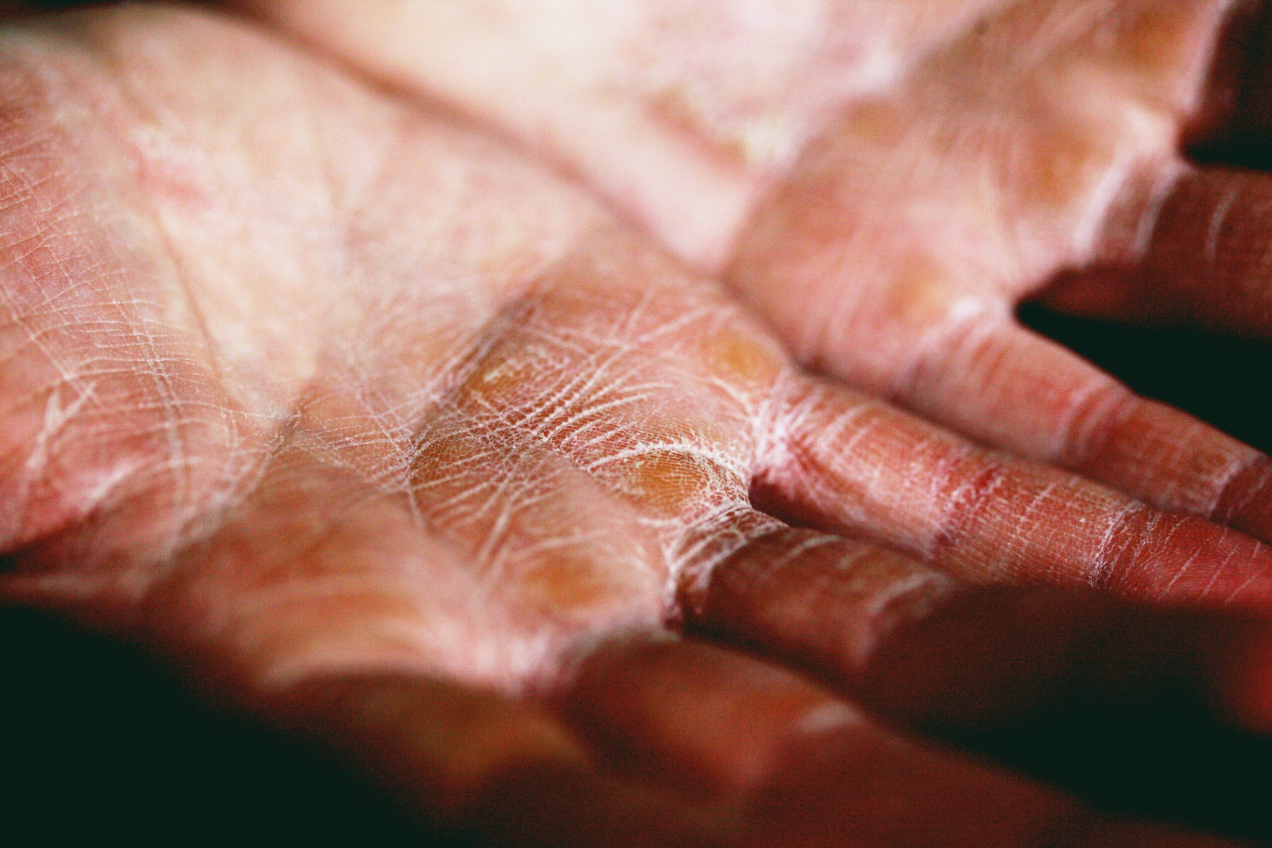 leprosy-what-is-causes-types-diagnosis-and-treatment-787129 leprosy-what-is-causes-types-diagnosis-and-treatment-787129