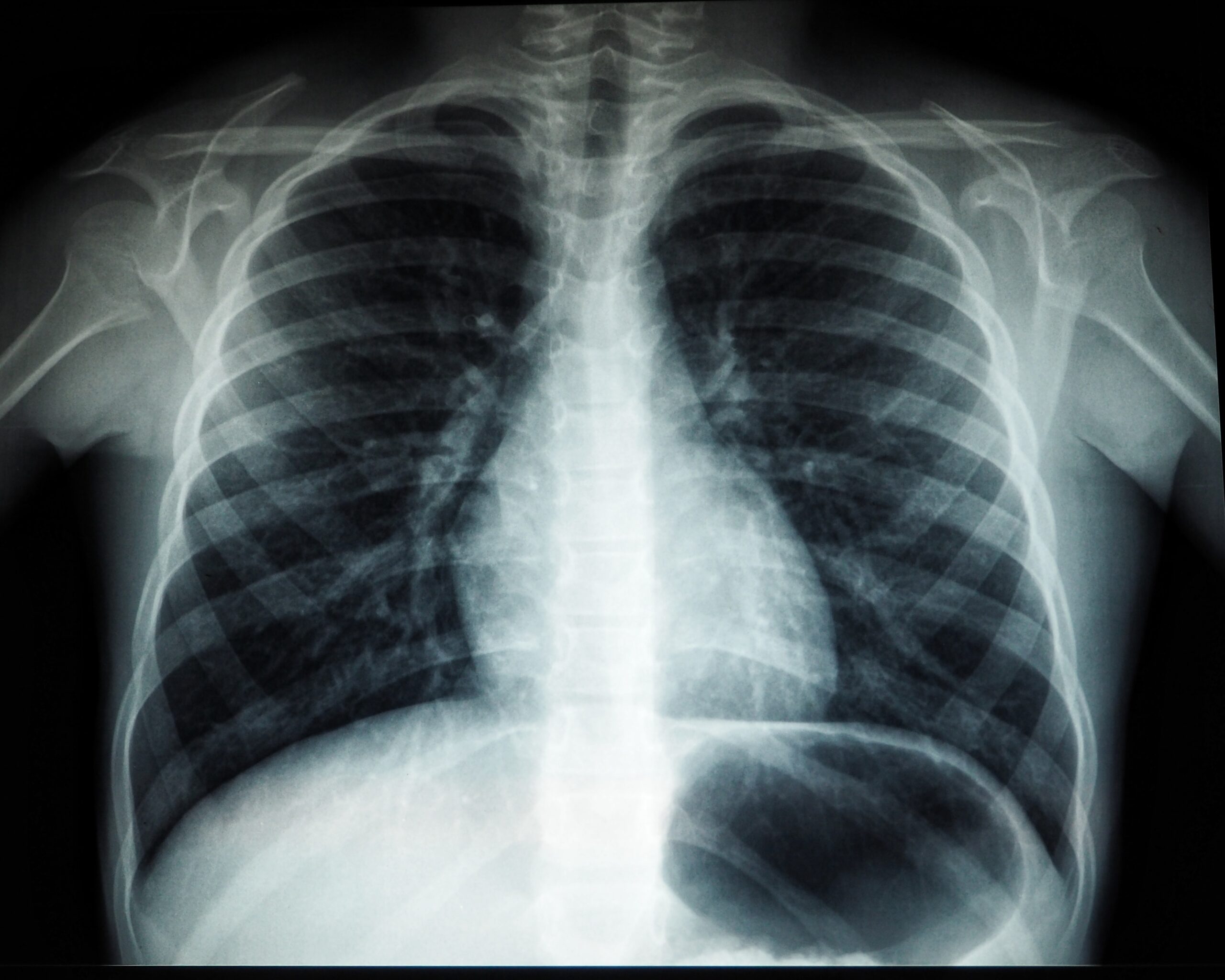 pericarditis-what-is-types-causes-treatment-and-prevention-669301 pericarditis-what-is-types-causes-treatment-and-prevention-669301