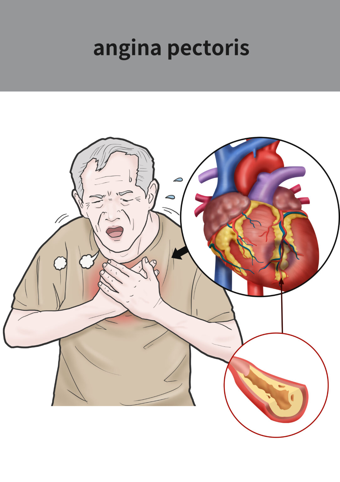 Medical,Illustration,For,Explanation,Angina,Pectoris