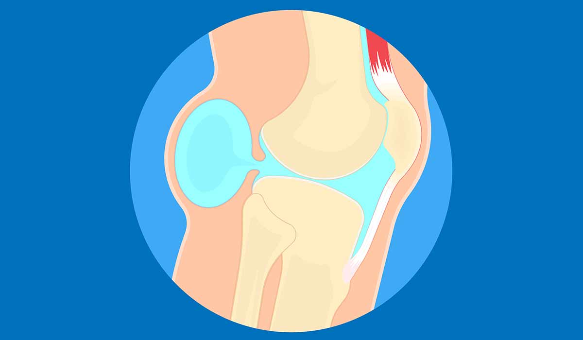 Baker’s Cyst