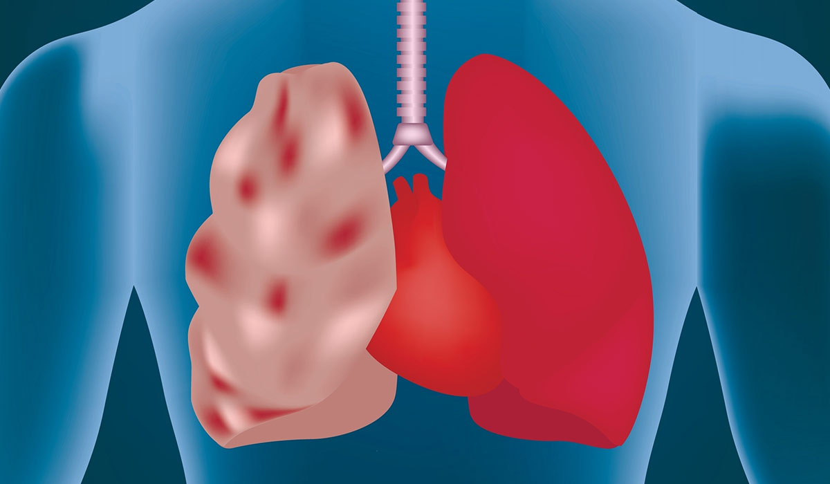 Emphysema