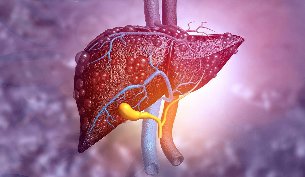 Fatty Liver
