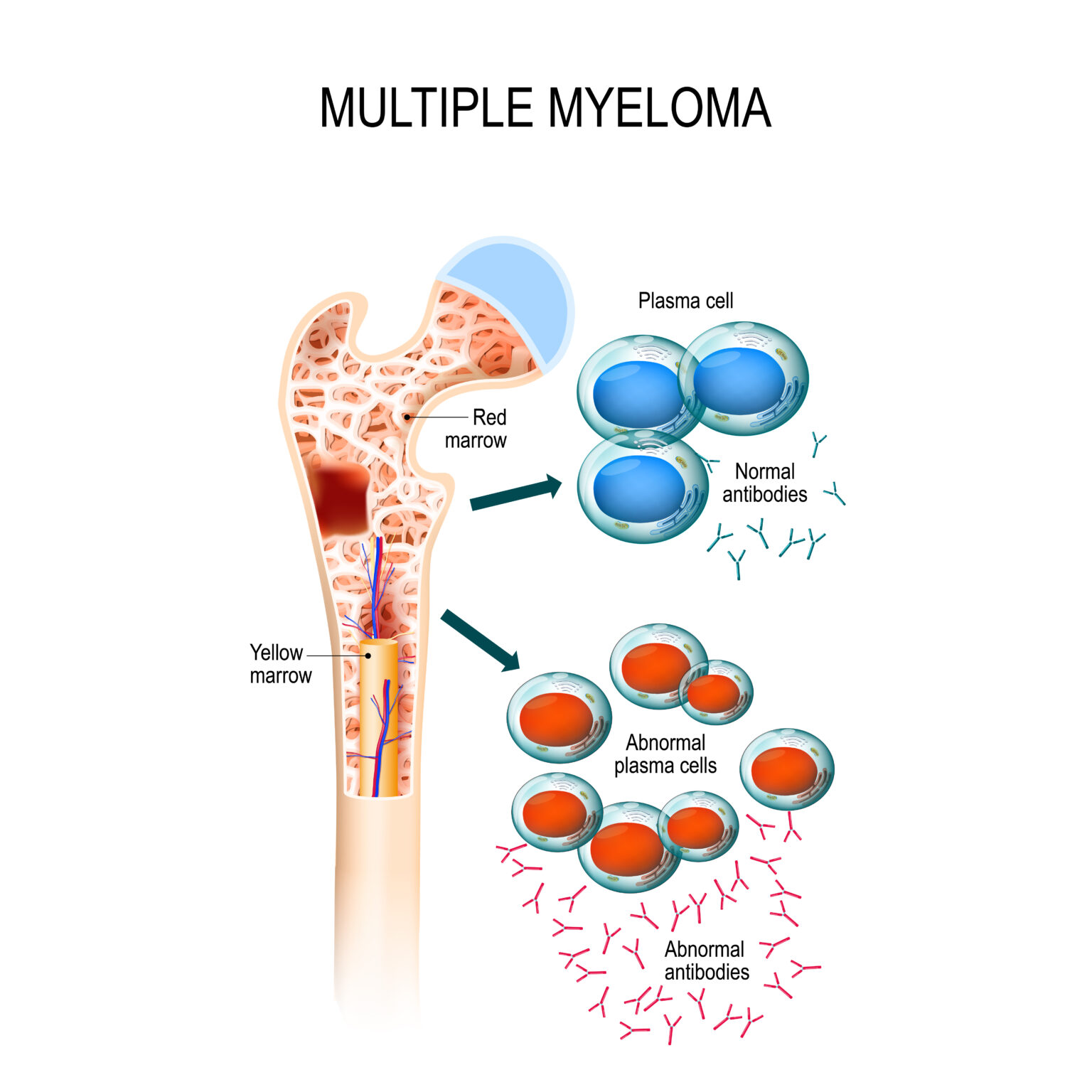 Multiple,Myeloma,Is,A,Cancer,Of,The,Bone,Marrow.,Healthy Multiple,Myeloma,Is,A,Cancer,Of,The,Bone,Marrow.,Healthy