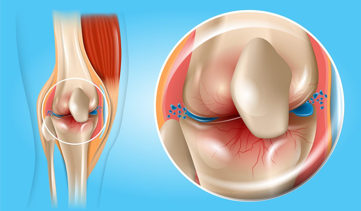 Osteoarthritis