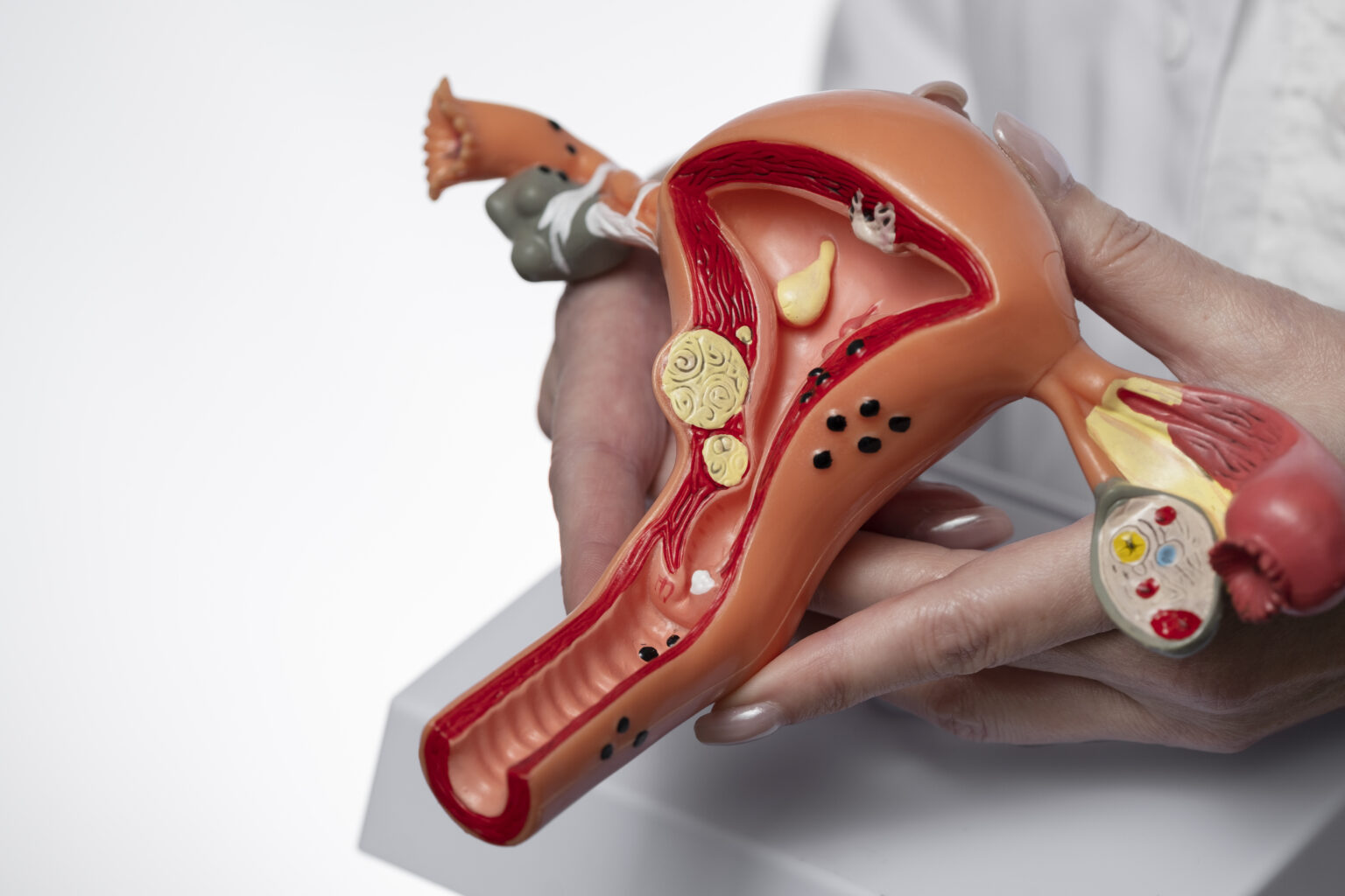 ovarian-cyst-what-is-pathologies-amp-symptoms-331272 ovarian-cyst-what-is-pathologies-amp-symptoms-331272