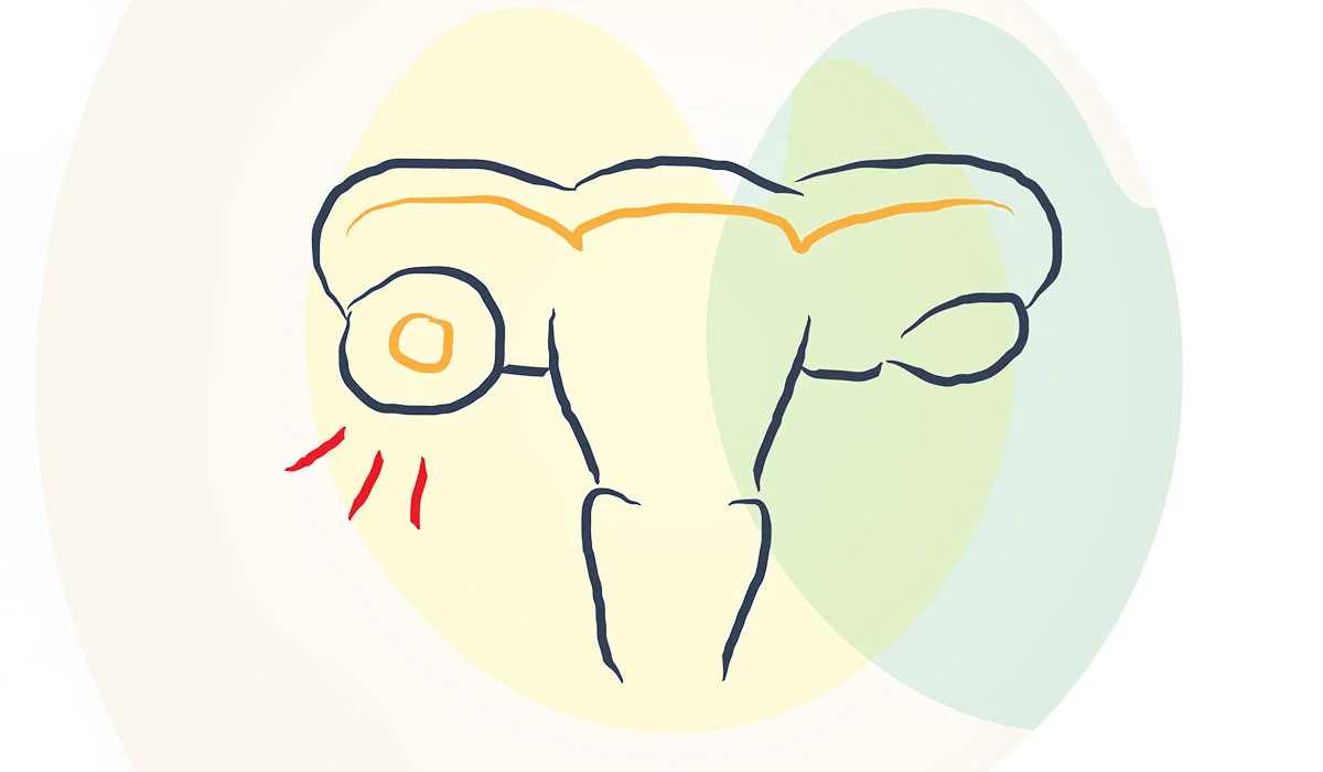 Ovarian Cyst