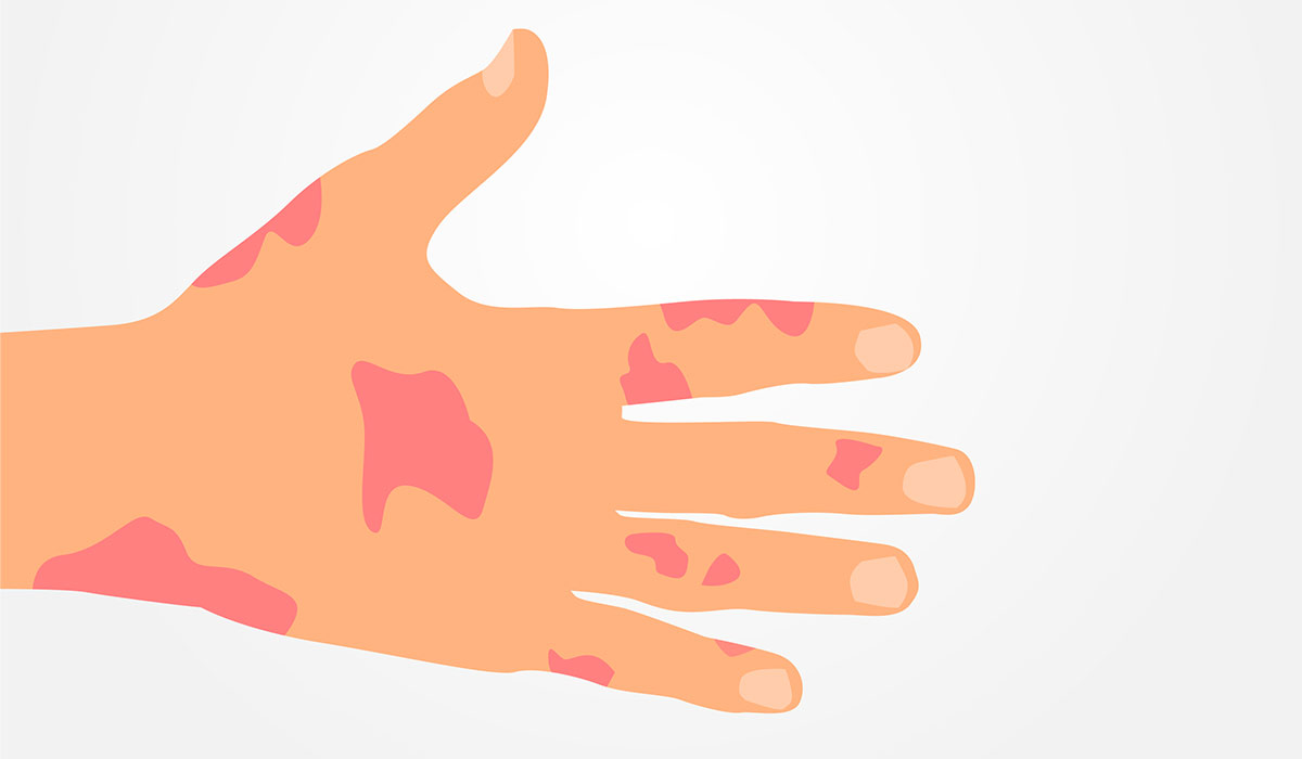 Psoriatic Arthritis