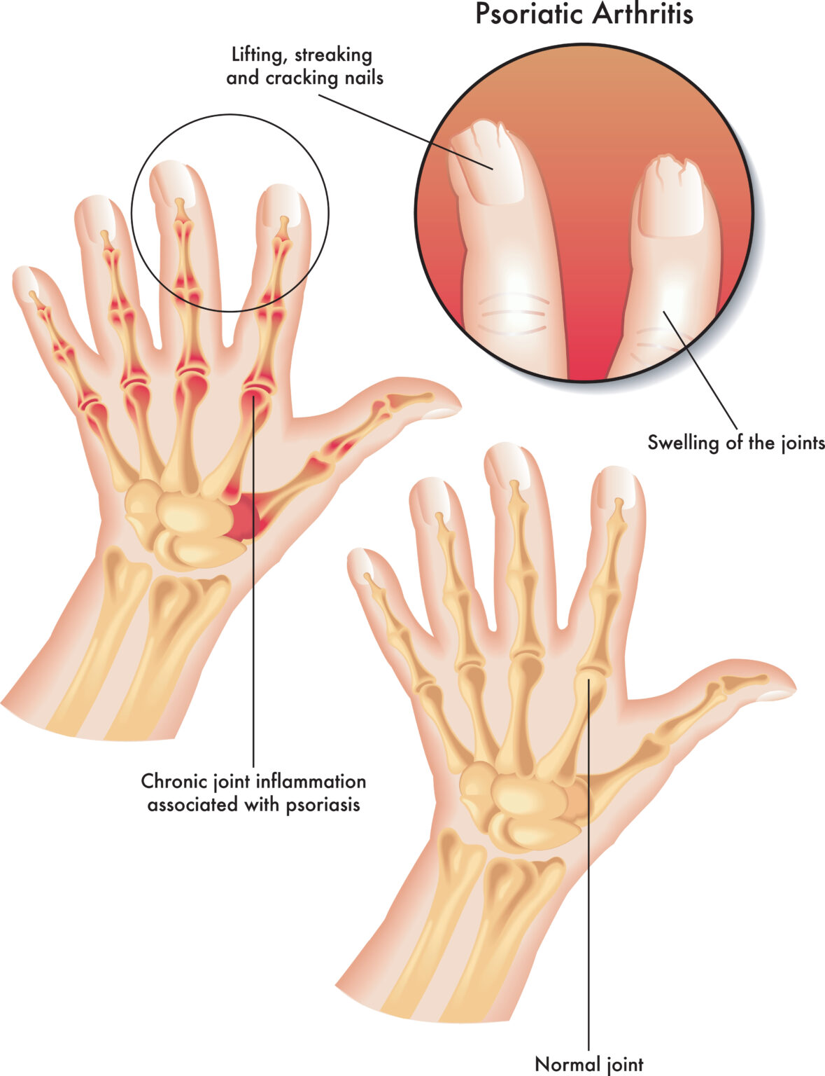 Medical,Illustration,Of,The,Symptoms,Of,Psoriatic,Arthritis. Medical,Illustration,Of,The,Symptoms,Of,Psoriatic,Arthritis.