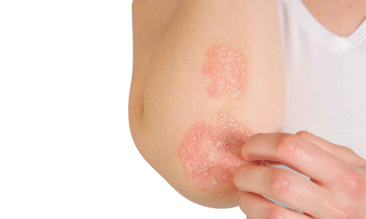 Acute,Psoriasis,On,The,Skin,,body,,,Is,An,Autoimmune Acute,Psoriasis,On,The,Skin,,body,,,Is,An,Autoimmune