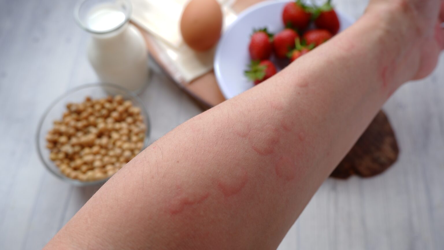 Close,Up,Image,Of,Arm,Suffering,Severe,Urticaria,Or,Hives Close,Up,Image,Of,Arm,Suffering,Severe,Urticaria,Or,Hives