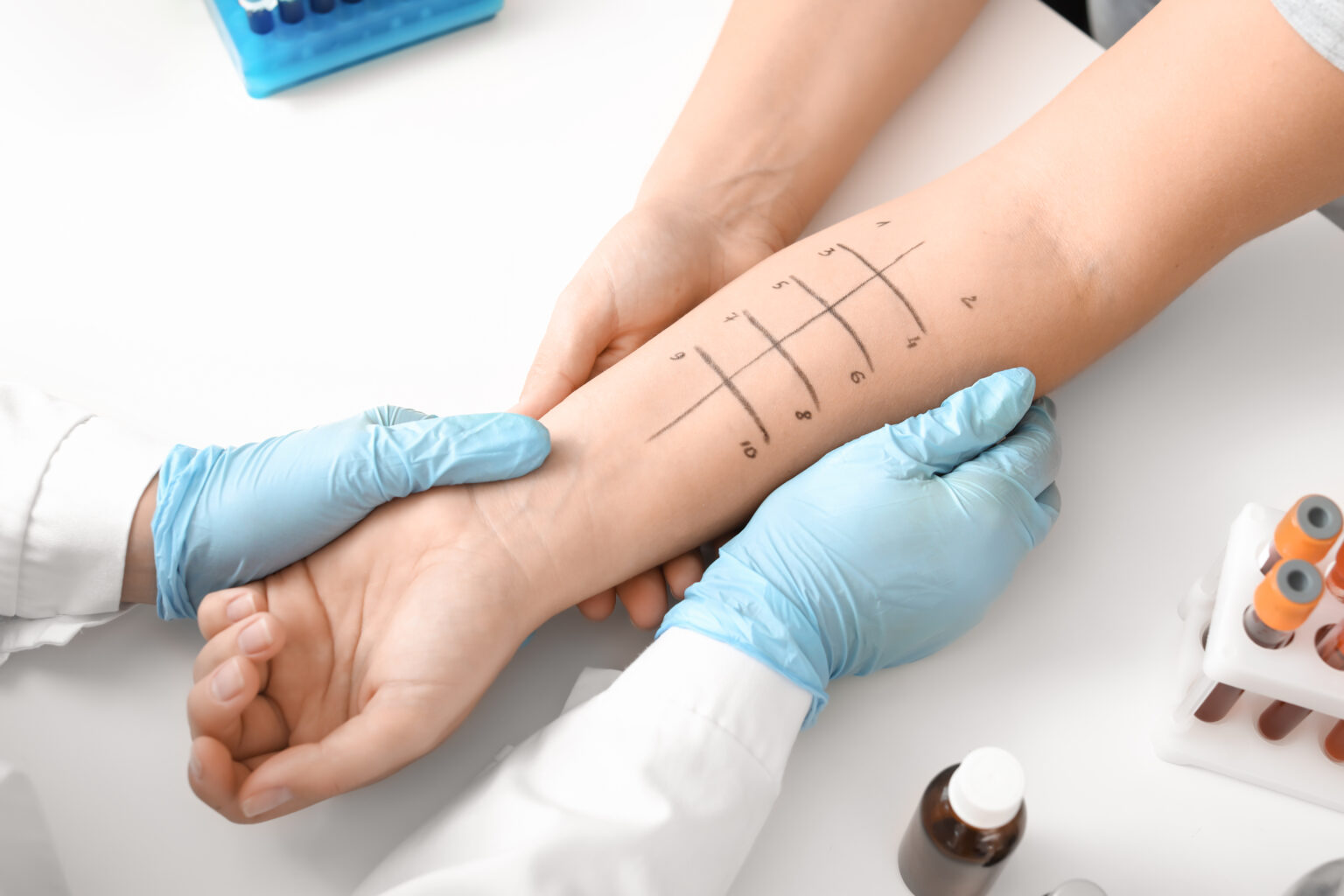 Young,Woman,Undergoing,Procedure,Of,Allergen,Skin,Tests,In,Clinic Young,Woman,Undergoing,Procedure,Of,Allergen,Skin,Tests,In,Clinic